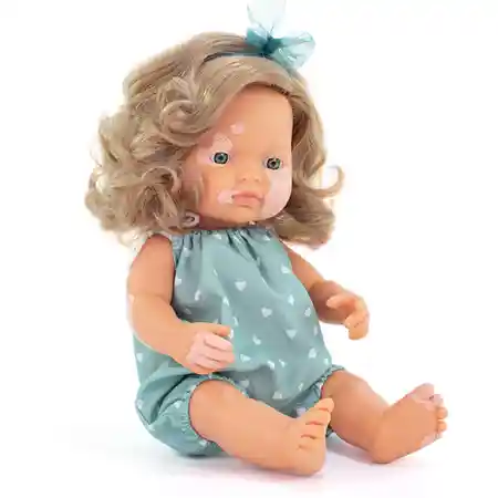 Doll with Vitiligo